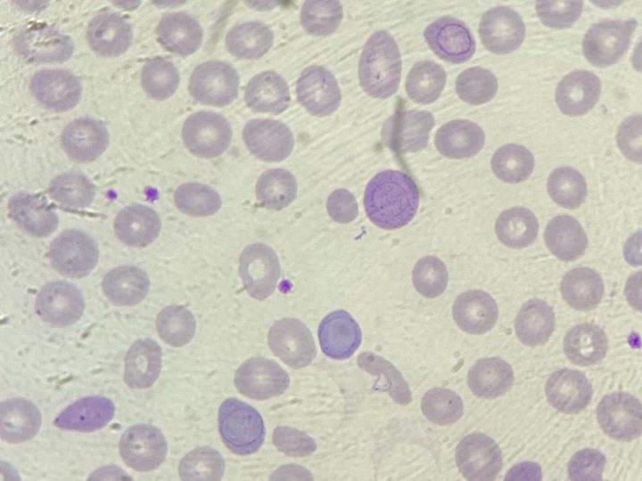 Blood smear: Cabot rings in several erythrocytes