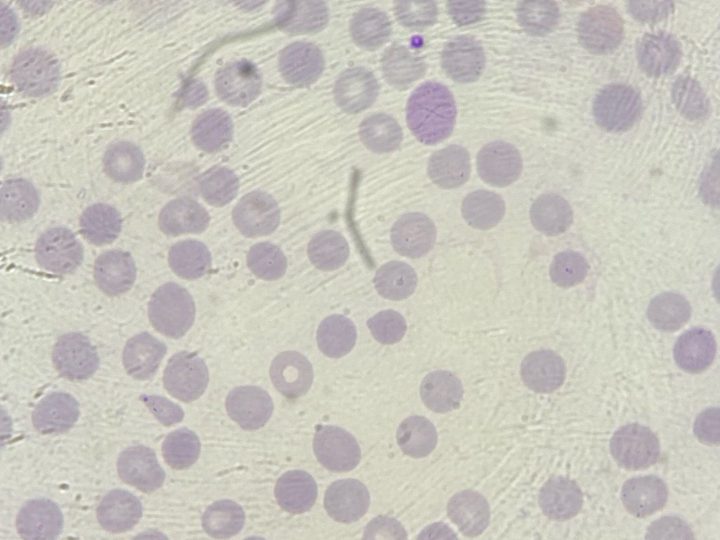 Blood smear: macrocyte with a thin Cabot ring