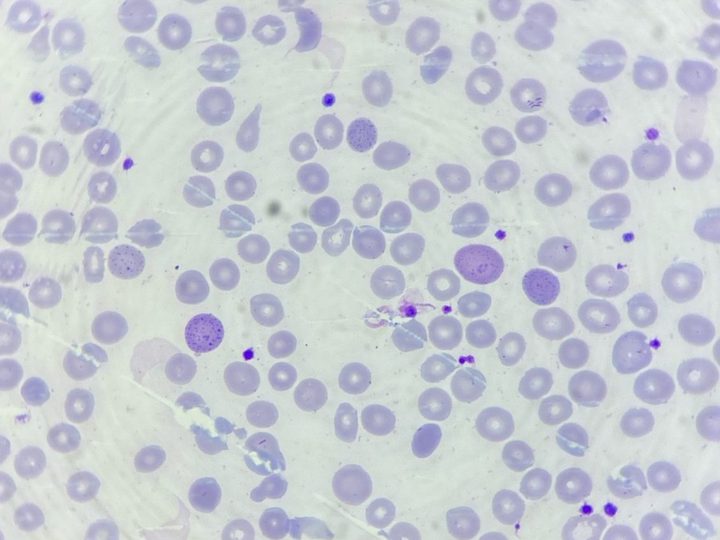 Blood smear: multiple erythrocytes with basophilic granularity