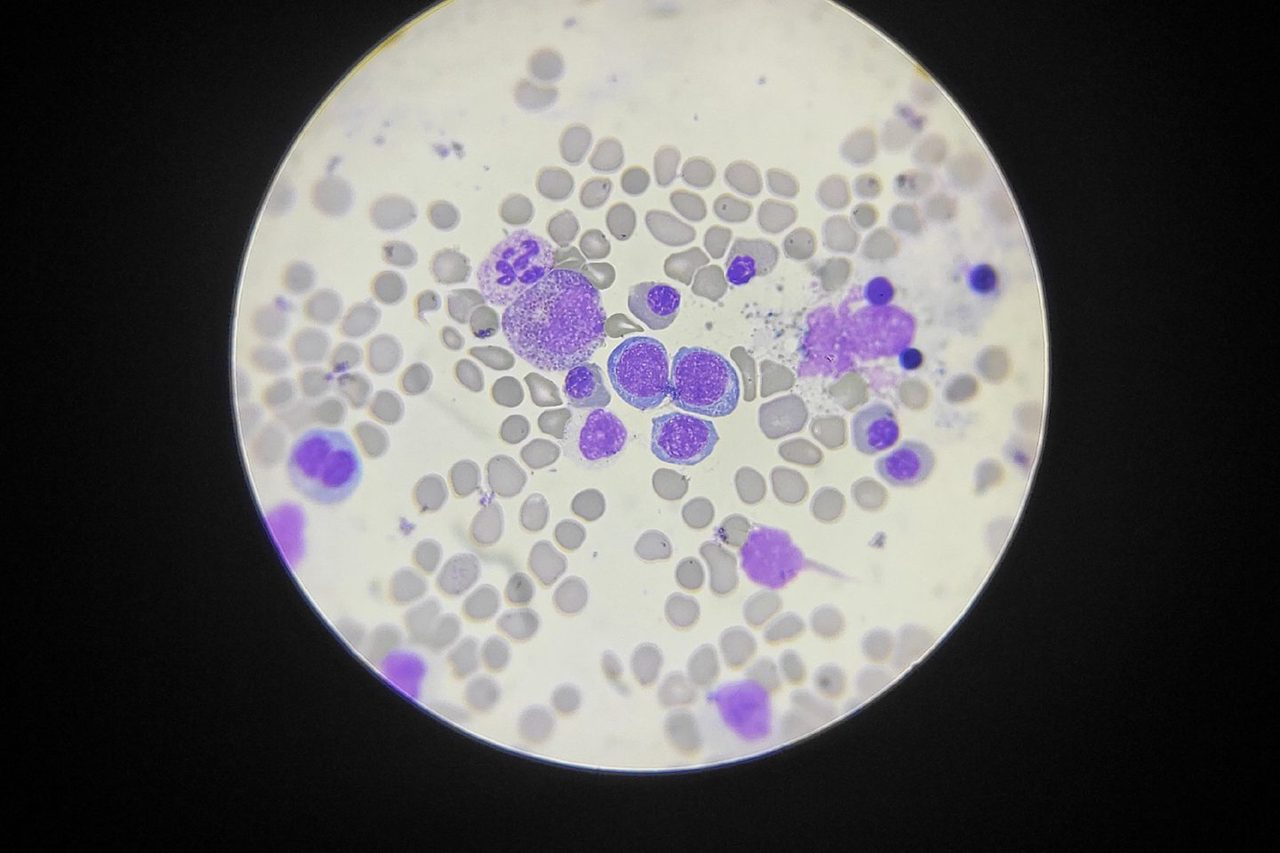 Megaloblasts and Dyserythropoiesis in Anemia During Pregnancy