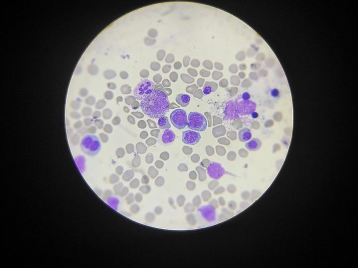 Bone marrow smear: megaloblasts and granulocytic lineage cells in anemia