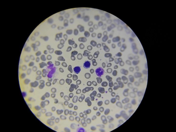 Bone marrow smear: erythroid precursors with a thin intercellular bridge