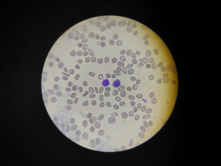 Bone marrow smear: a pair of erythrokaryocytes against a background of pronounced anisopoikilocytosis