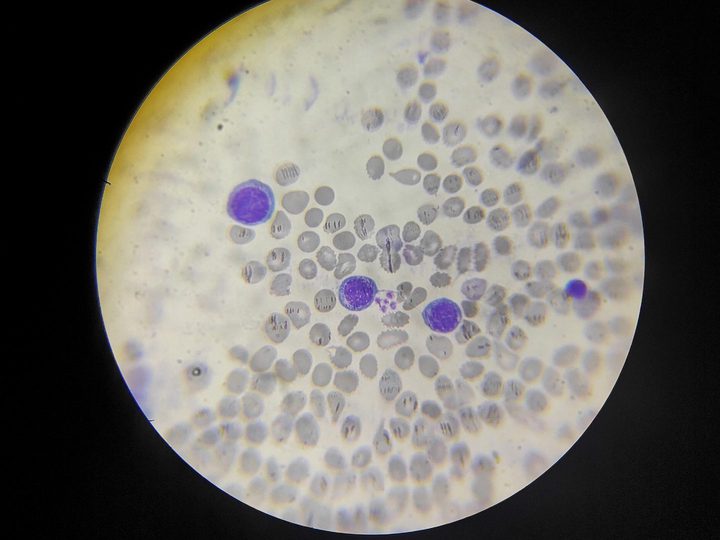 Bone marrow smear: megaloblastic erythroid cells and platelets