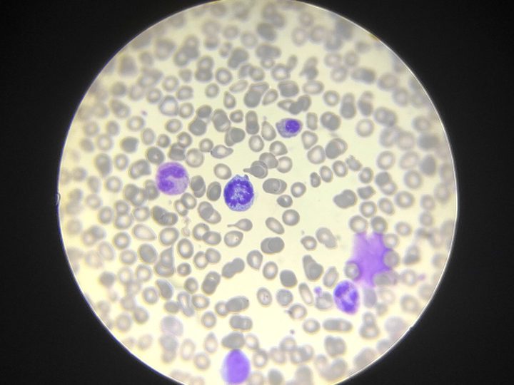Bone marrow smear: mitotic figure in the center of the field of view and erythroid cells