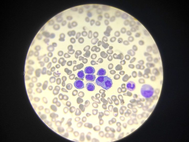 Bone marrow smear: compact erythroblastic island with maturation asynchrony