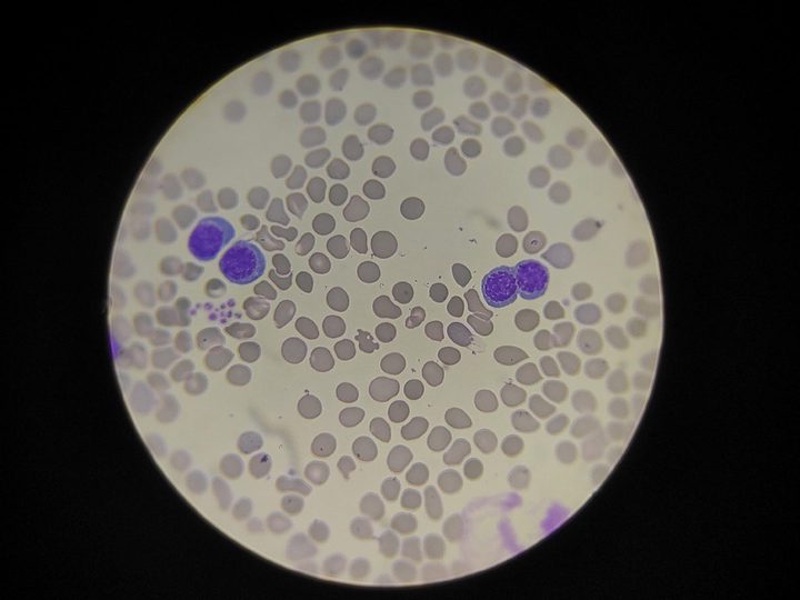 Bone marrow smear: binucleated precursor and megaloblasts in aspirate