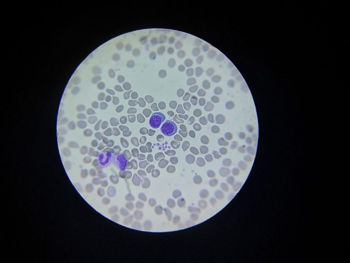 Bone marrow smear: a pair of connected erythroblasts with signs of impaired cytokinesis