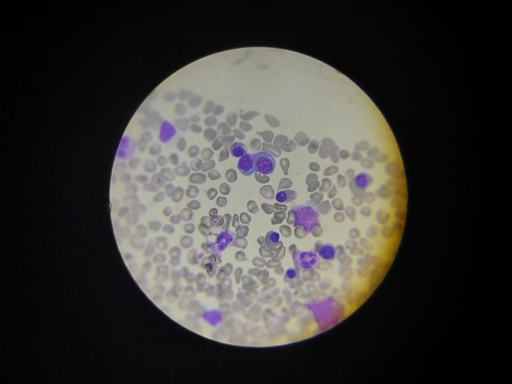 Bone marrow smear: signs of dyserythropoiesis and erythroid lineage cells