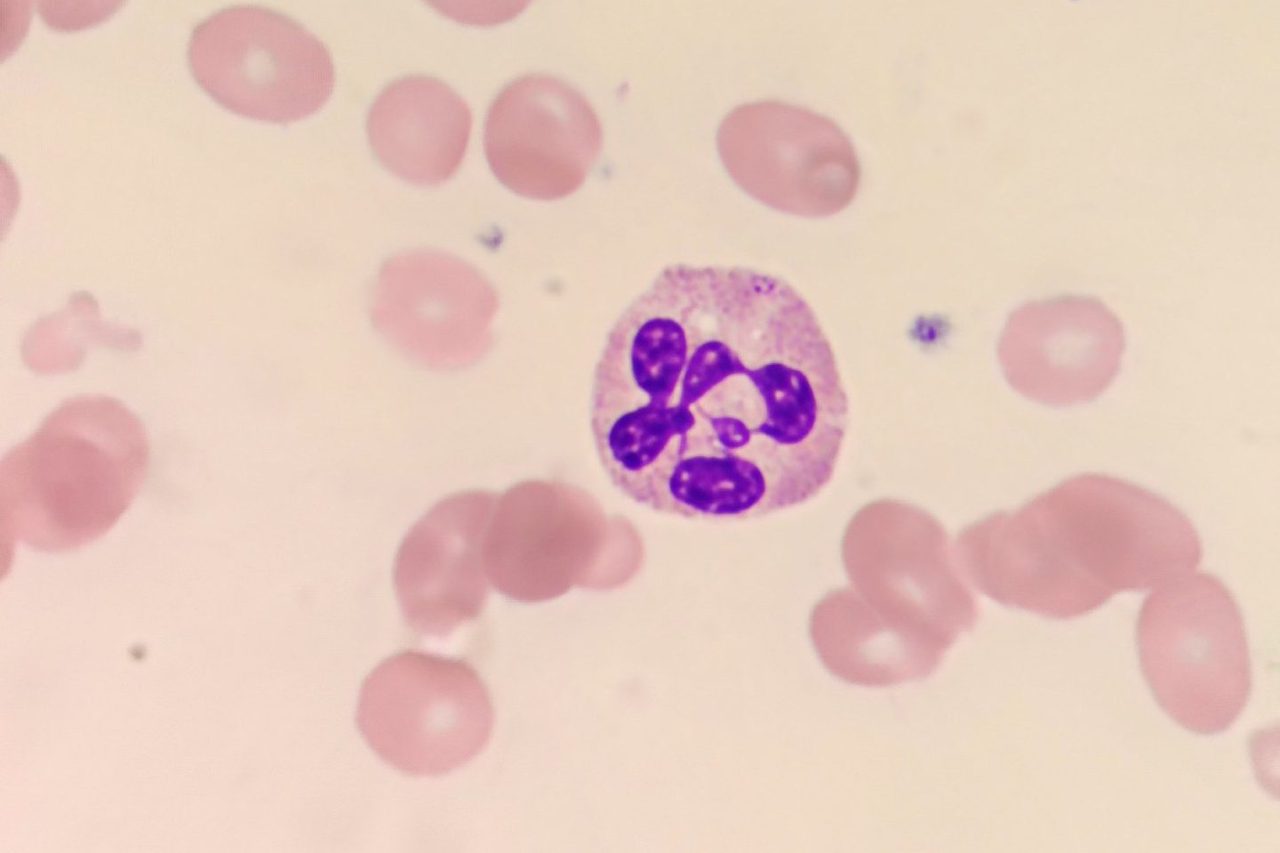 Megaloblasts in Blood Smear with Macrocytic Anemia