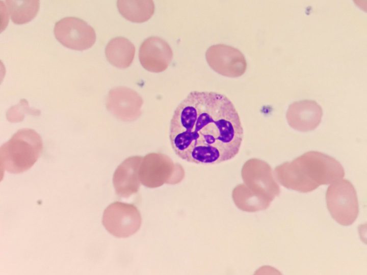 Blood smear: hypersegmented neutrophil with six nuclear segments