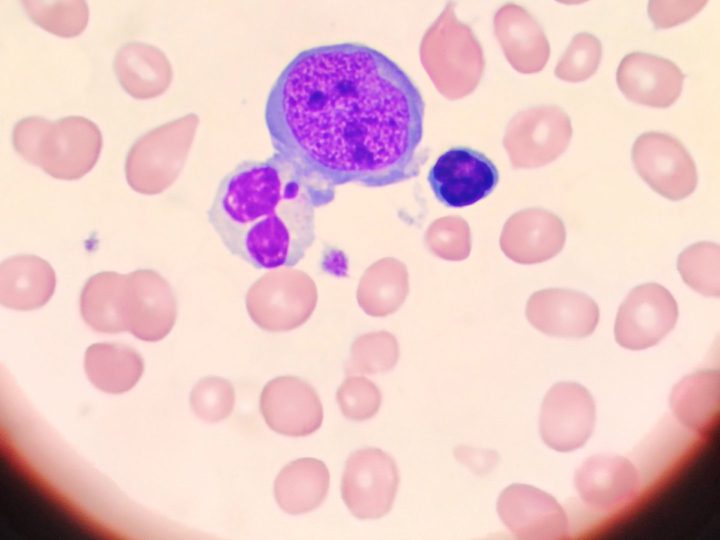 Blood smear: basophilic megaloblast in peripheral circulation