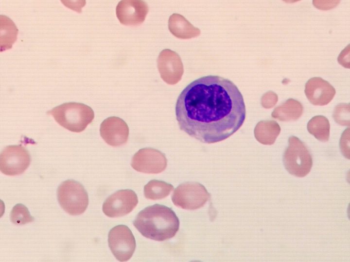 Blood smear: polychromatophilic megaloblast and marked poikilocytosis