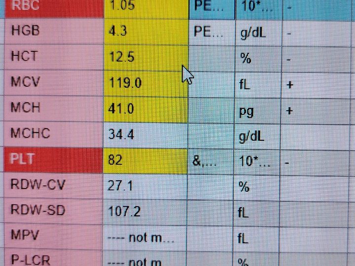 Sysmex XN analyzer printout: severe anemia, MCV 119 fL, thrombocytopenia