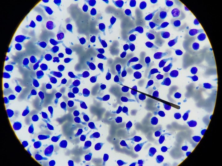 Canine lymph node aspirate smear: accumulation of monomorphic small lymphocytes