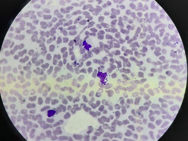 Мазок крови: фагоцитоз Neisseria meningitidis нейтрофилами при бактериемии