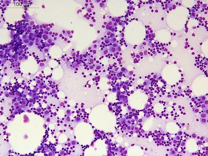 Цитологический препарат пунктата лимфоузла: скопления клеток карциномы и лимфоциты