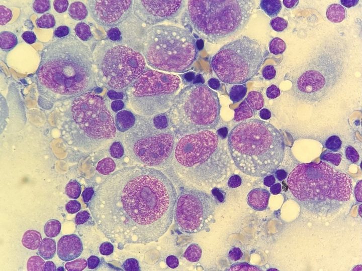 Цитологический мазок: клетки карциномы с крупными ядрышками среди лимфоцитов