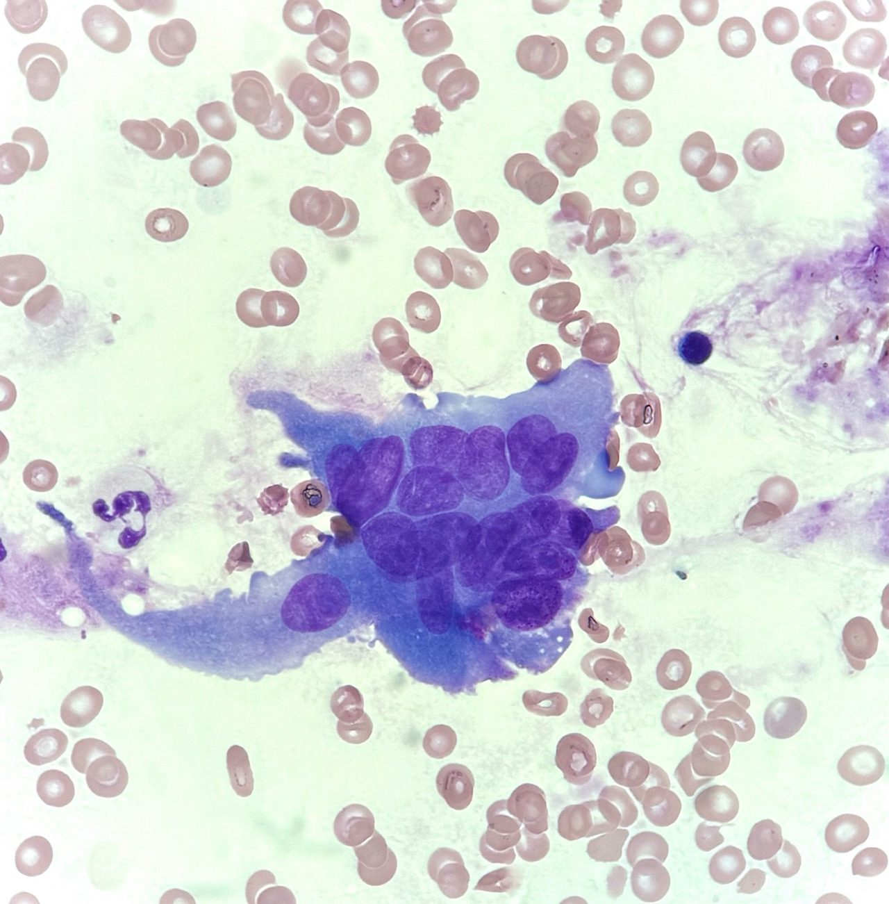 Prostate Cancer Metastasis to Bone Marrow: Cytology