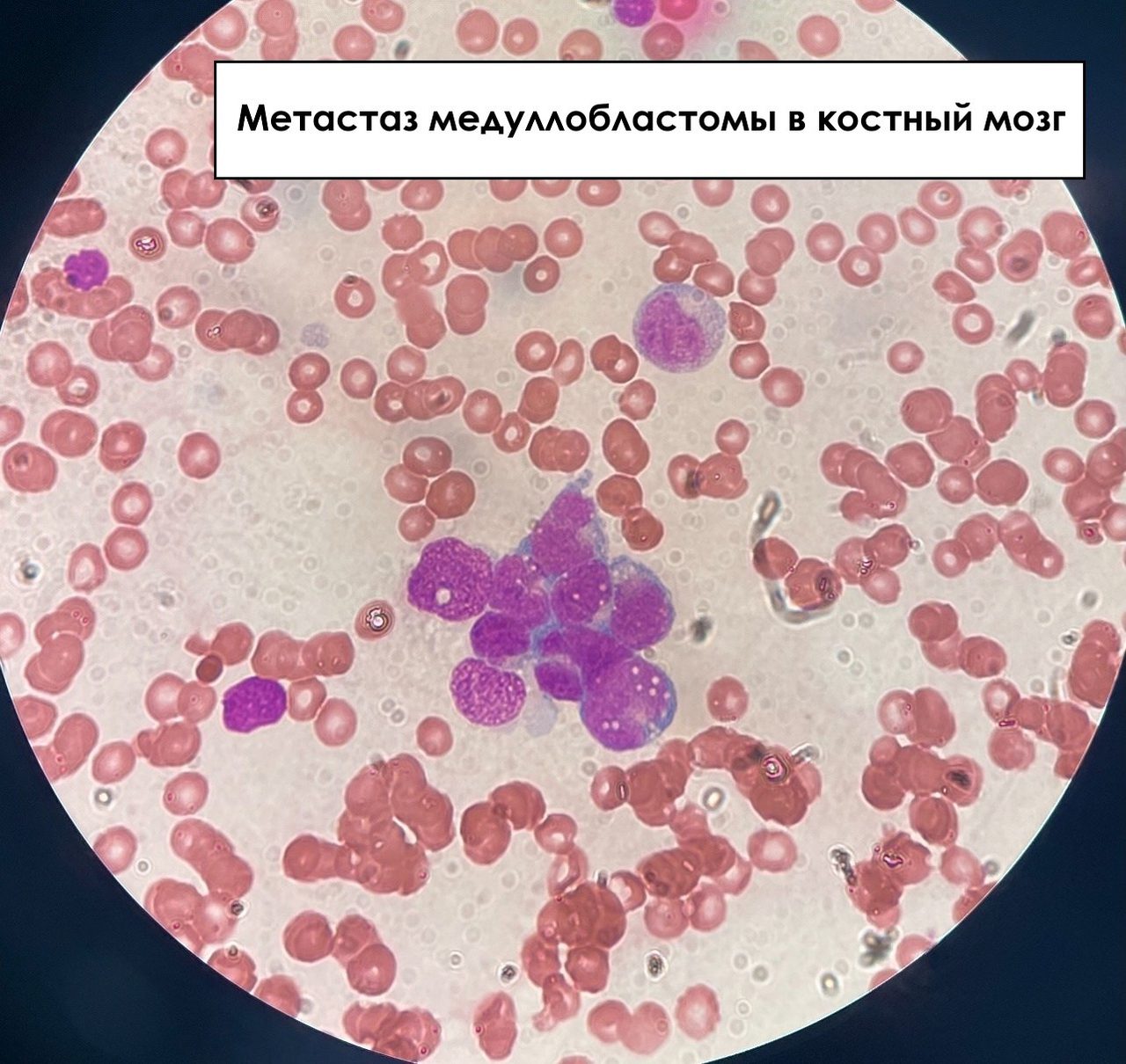 Метастазы солидных опухолей в костный мозг: цитология