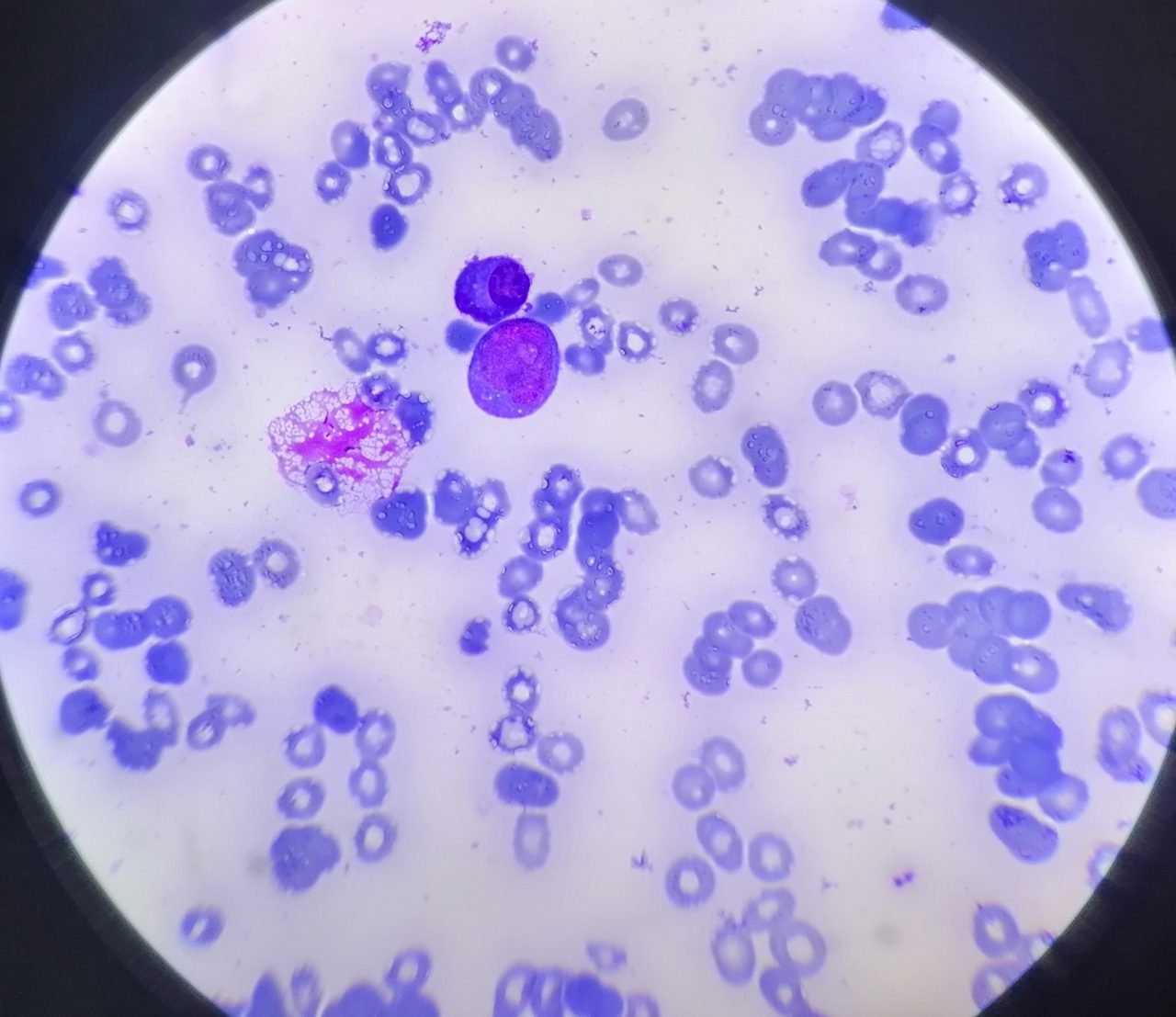 Myelodysplastic Syndrome: Bone Marrow Morphology