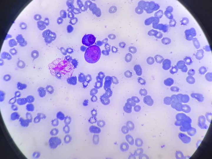 Bone marrow smear, blast cell and normoblast in scanty aspirate