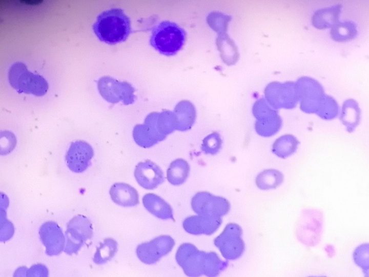 Bone marrow smear, erythroblasts with a thin cytoplasmic bridge