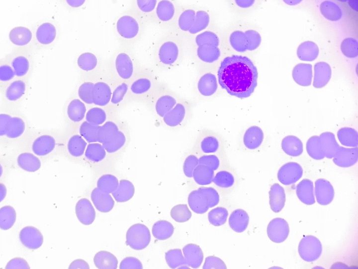 Bone marrow smear, normoblast with signs of dyserythropoiesis
