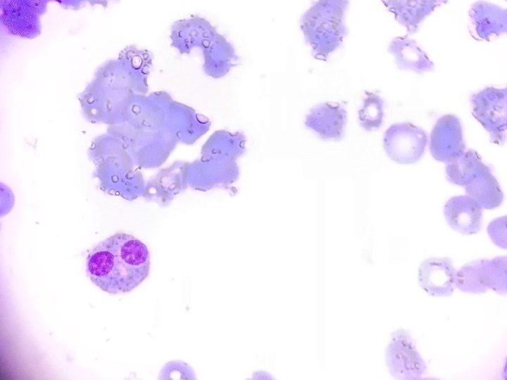 Bone marrow smear, binucleated normoblast in myelodysplasia