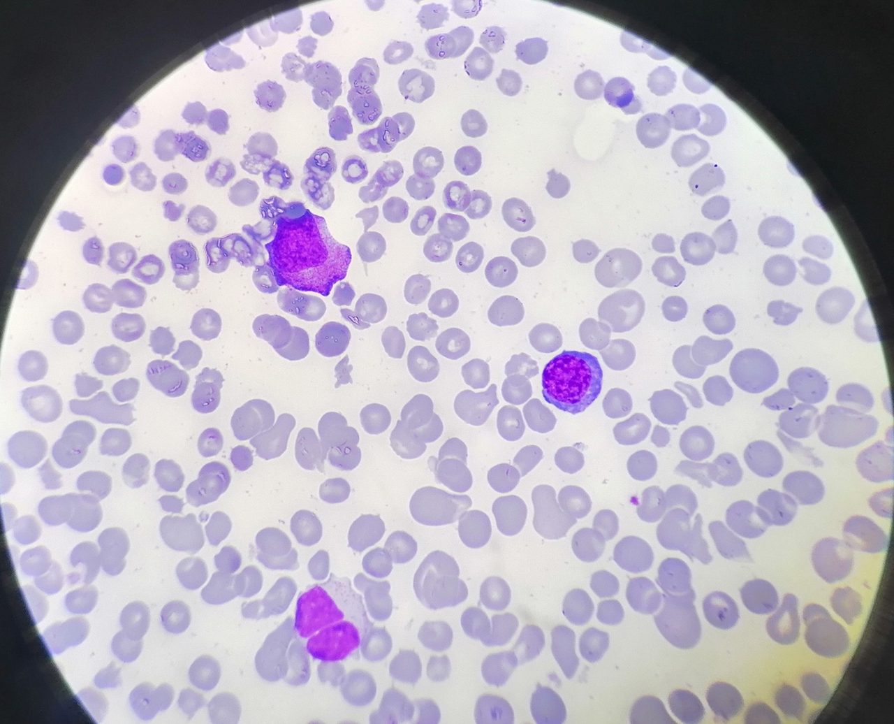 Myelodysplastic Syndrome: Bone Marrow Morphology