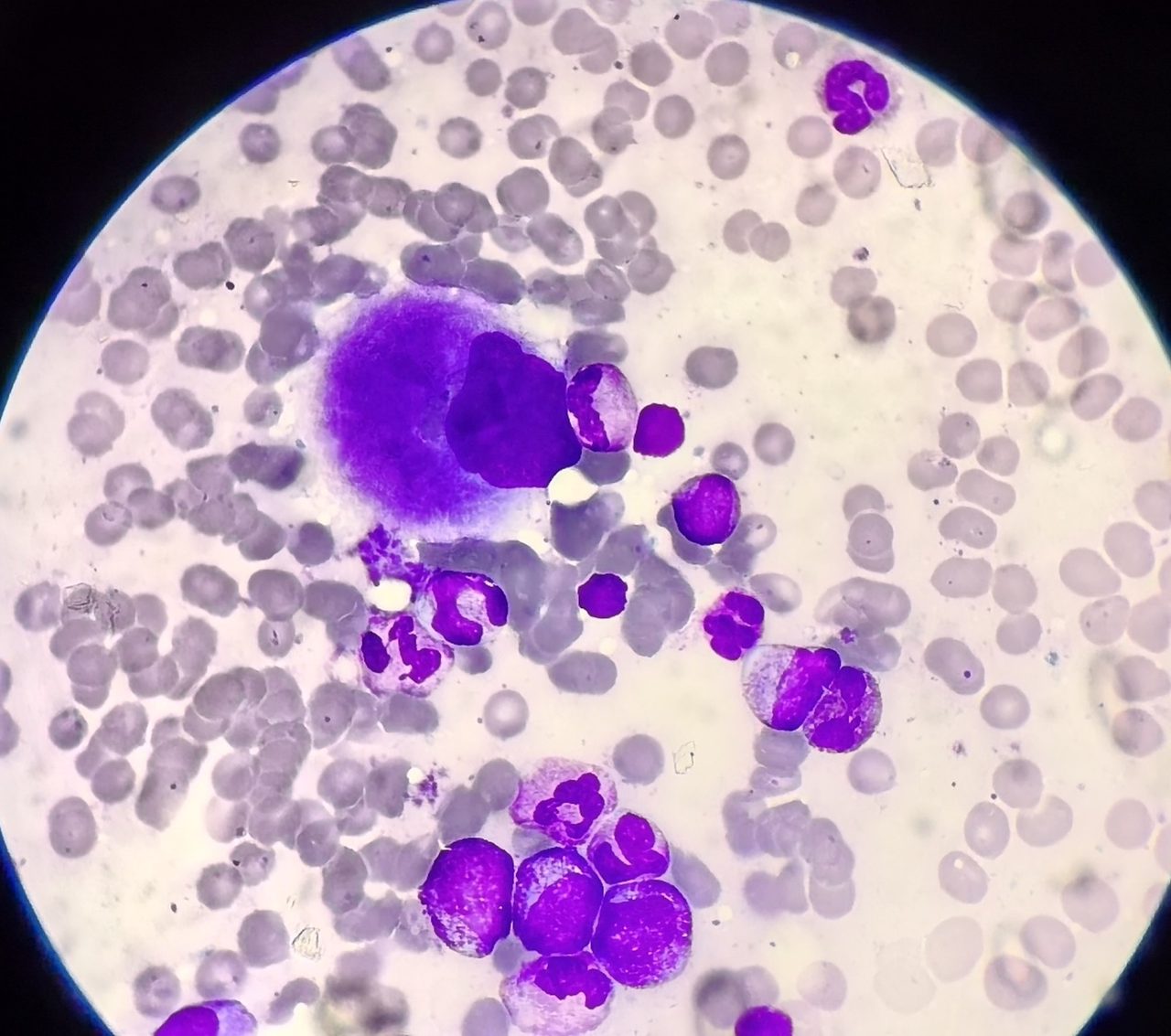 Myeloproliferation: Bone Marrow Findings