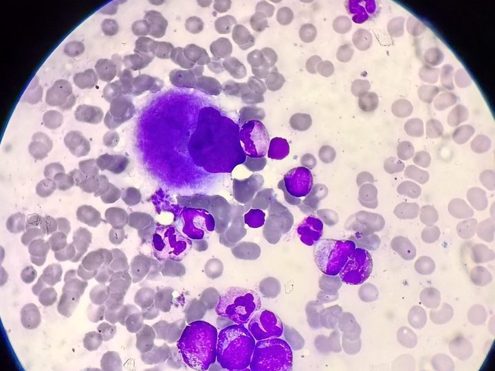 Bone marrow smear: megakaryocyte and granulocytic lineage in myeloproliferation