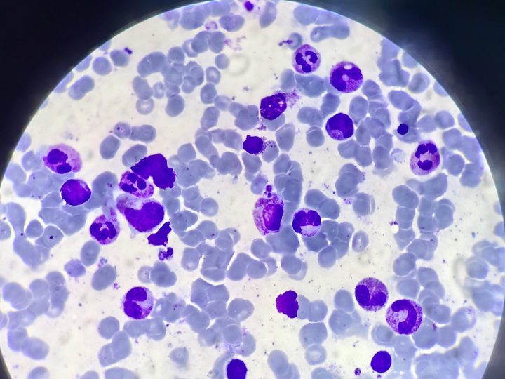 Bone marrow smear: granulocytic lineage cells, erythrocytes