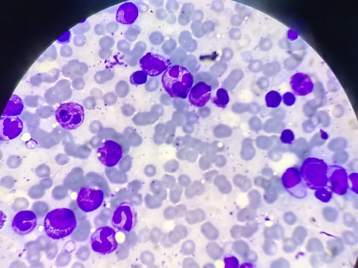Bone marrow smear: myelocytes, metamyelocytes, neutrophils