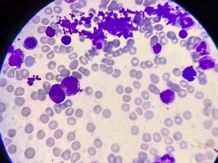 Bone marrow smear: platelet aggregates and granulocytic lineage cells