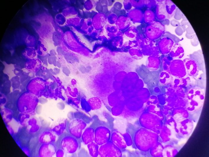 Bone marrow smear, hypersegmented megakaryocyte among granulocytes