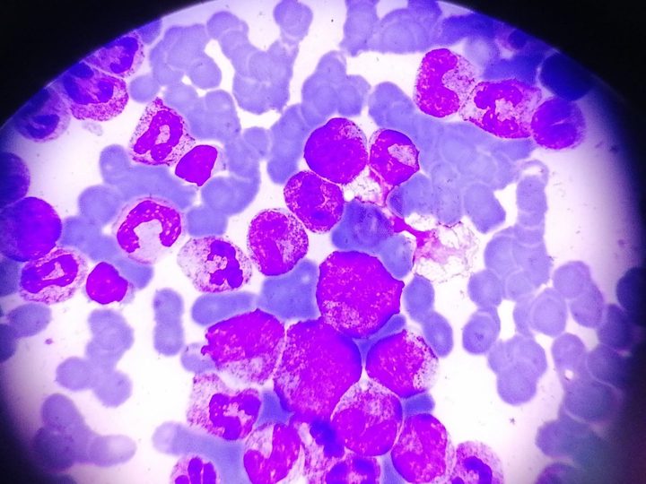 Bone marrow smear, granulocytic lineage at different stages of maturity