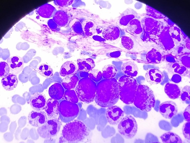 Bone marrow smear, marked predominance of granulocytopoiesis cells