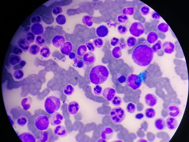 Bone marrow smear, promyelocytes, myelocytes, and mature neutrophils