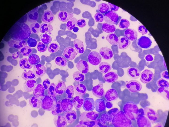Bone marrow smear, neutrophilic hyperplasia with abundant maturing forms