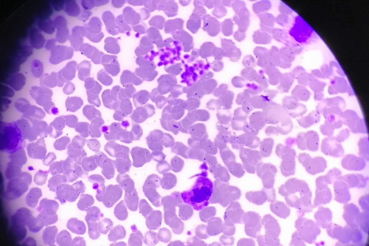 Myeloproliferative Neoplasms: Blood Smear and Bone Marrow