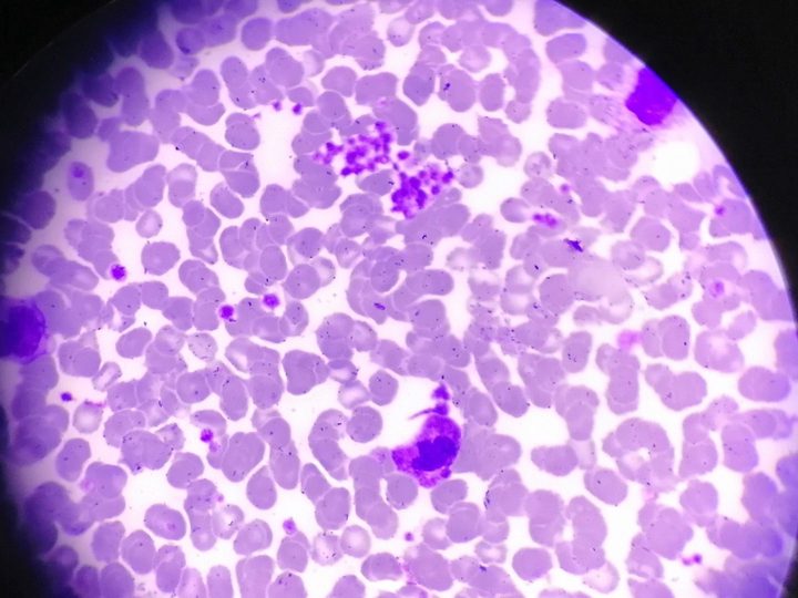 Peripheral blood smear: platelet aggregation and pronounced anisocytosis