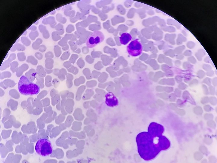 Bone marrow aspirate smear: megakaryocyte with lobulated nucleus among myeloid cells