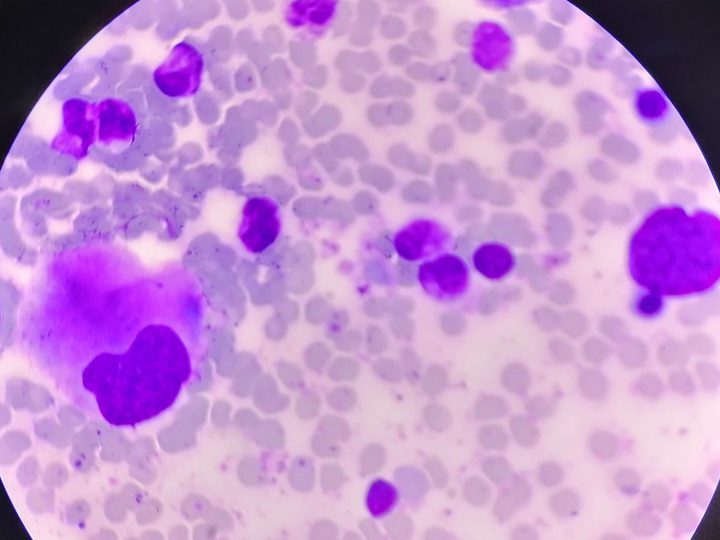 Bone marrow smear: hyperplasia of erythroid and megakaryocytic lineages