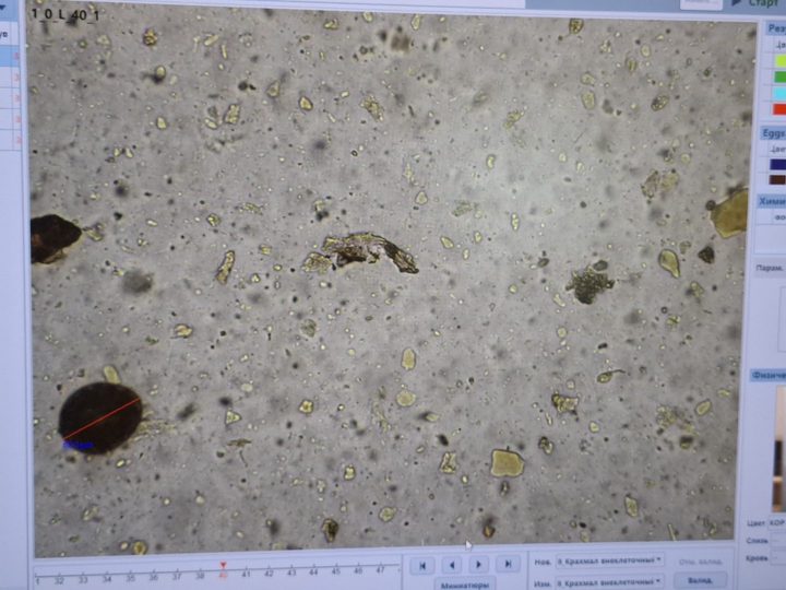Screen of an automatic fecal analyzer with a microphotograph of a suspicious object