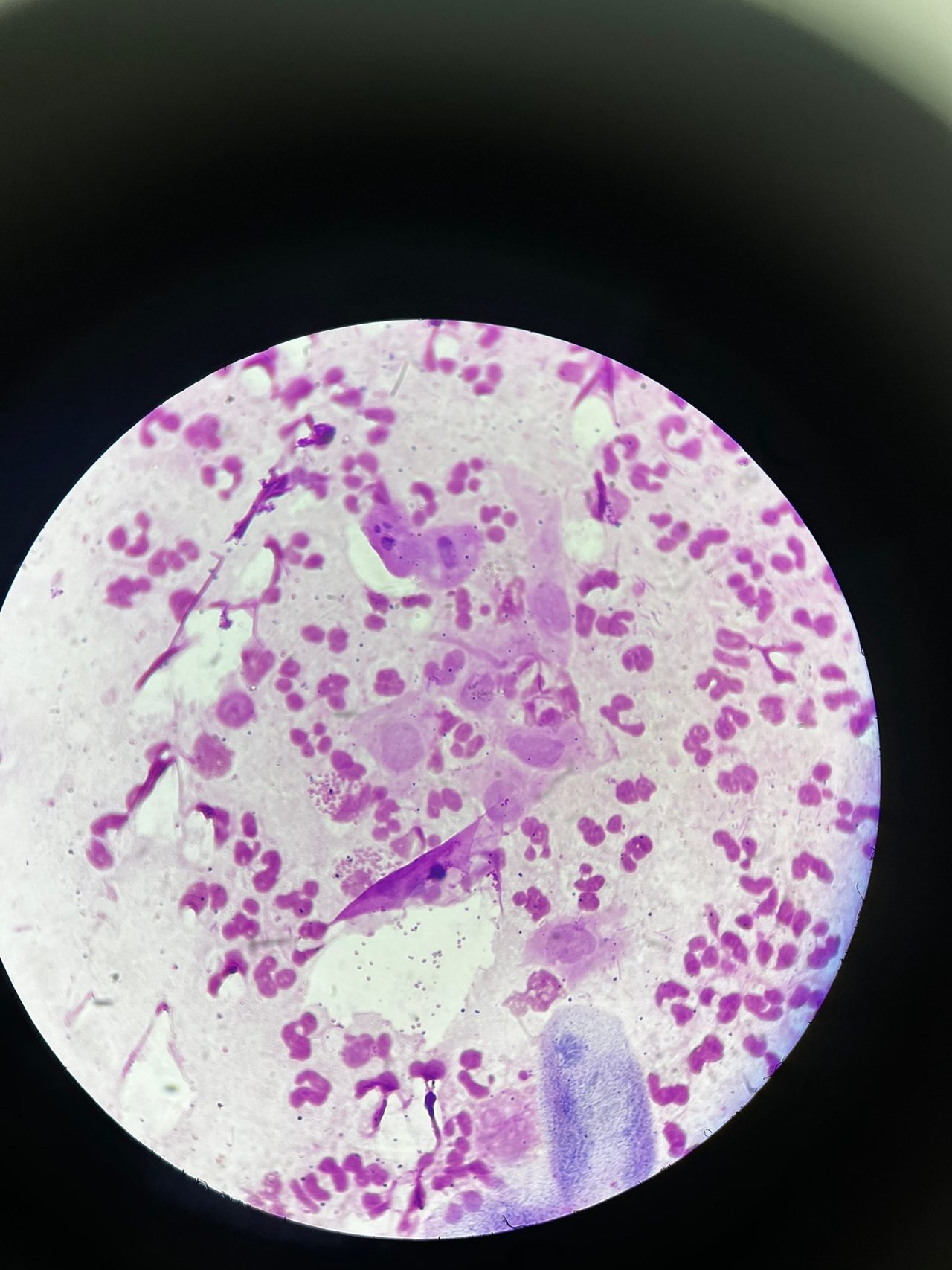Urethral Smear Microscopy: Detecting Neisseria gonorrhoeae
