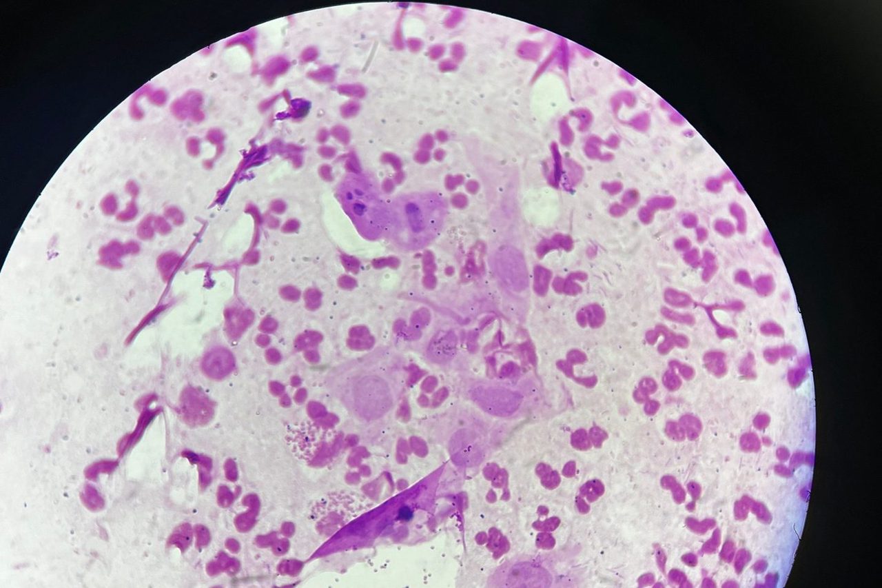 Микроскопия мазка из уретры: Neisseria gonorrhoeae