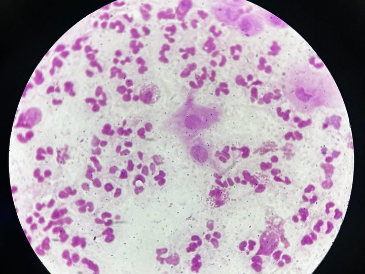 Мазок из уретры, внутриклеточное скопление Neisseria gonorrhoeae