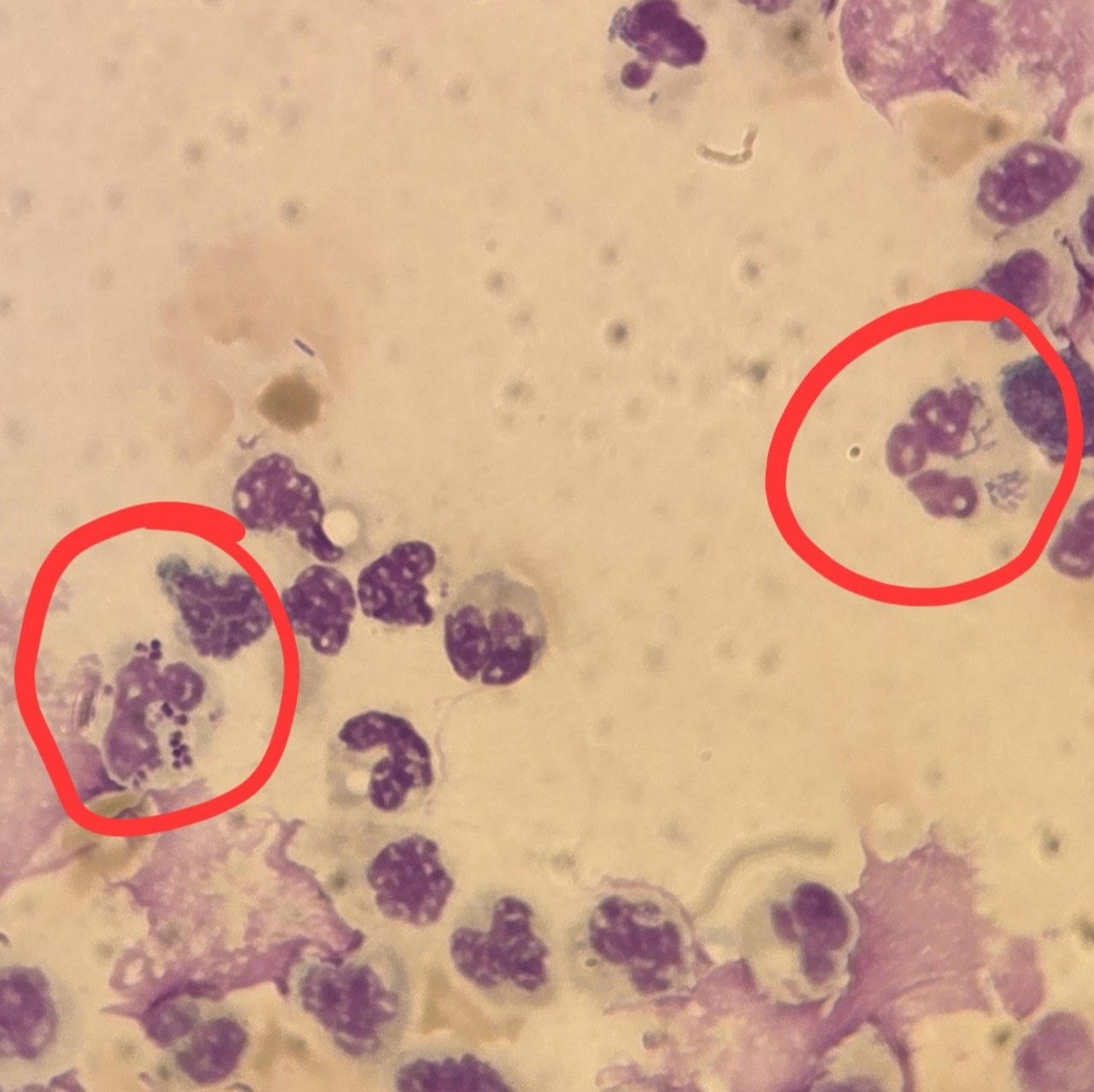 Urinary Sediment Microscopy: Neutrophil Phagocytosis of Bacteria