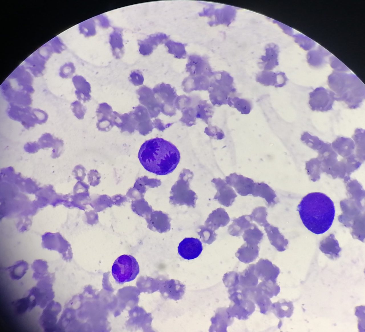 Erythroid Mitosis in Bone Marrow Smear: Morphological Features